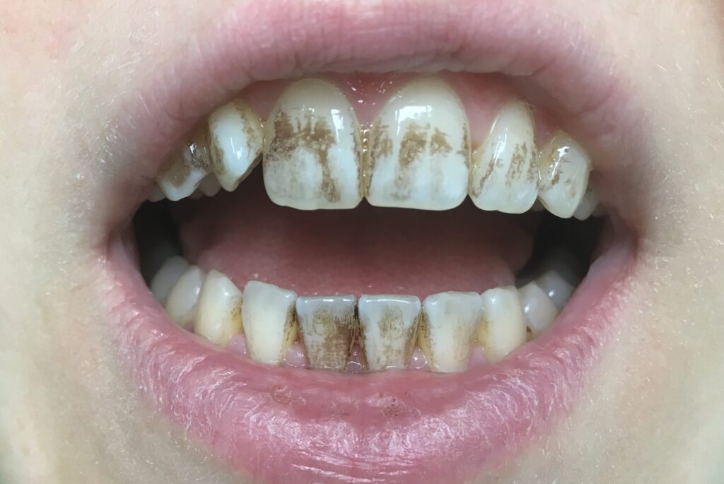 Pigmentové skvrny na zubech nebo umrtvený zub?